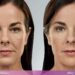 Dermal fillers Sydney before and after