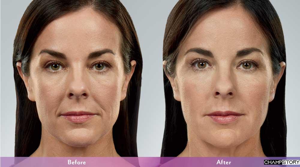Dermal fillers Sydney before and after