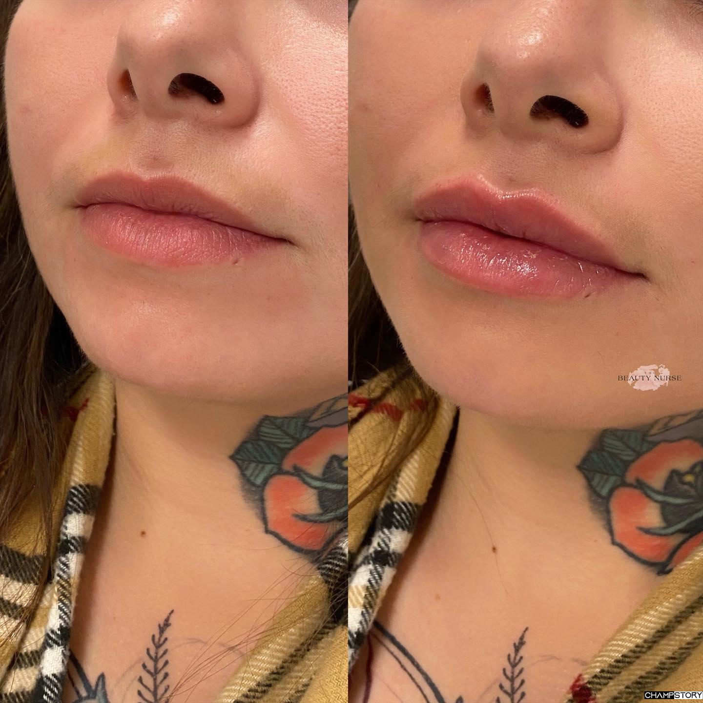 Lip Fillers Before and after Result