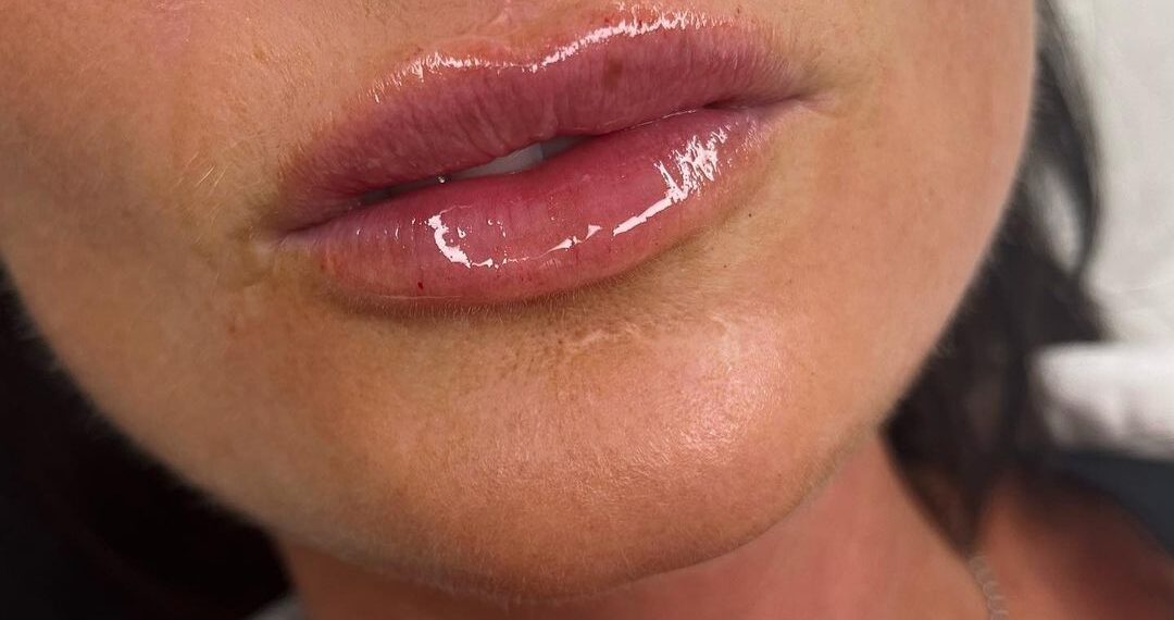 Lip Fillers in Perth