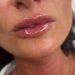 Lip Fillers in Perth