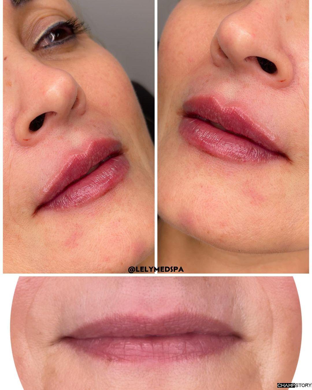 Lip Fillers Before and after Result