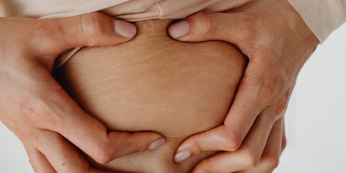 Laser Stretch Mark Removal Sydney