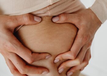 Laser Stretch Mark Removal Sydney