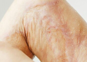 5 simple home remedies for minor burns
                              
                              Published by Livemint | 31 Oct 2024