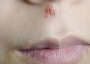 Top 5 cold sore remedies
                              
                              Published by Livemint | 09 Nov 2024